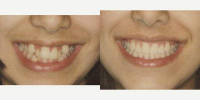 Braces before and after photo