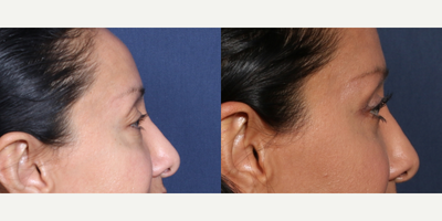 Eyelid Surgery before and after photo