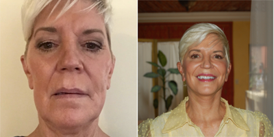 Facelift before and after photo