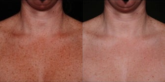 IPL before and after photo