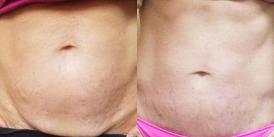 Morpheus8 before and after photo