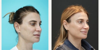 Neck Lift before and after photo