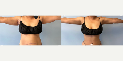 Tummy Tuck before and after photo