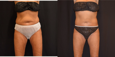 CoolSculpting before and after photo