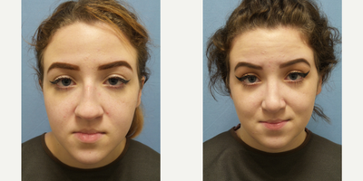 Rhinoplasty before and after photo