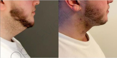 Chin Liposuction before and after photo