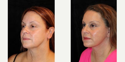 Facelift before and after photo
