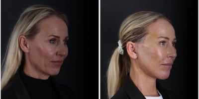 Facelift before and after photo