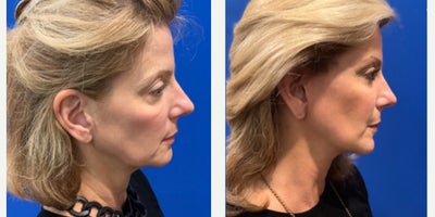 Mini Facelift before and after photo