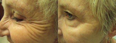 Botox before and after photo