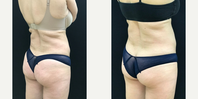 CoolSculpting before and after photo