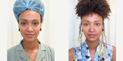 Eyelid Surgery before and after photo