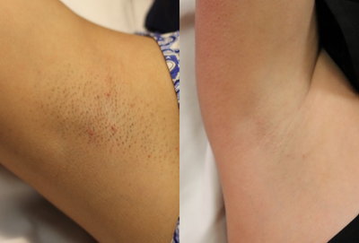 Laser Hair Removal before and after photo