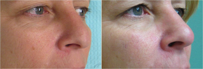 Nonsurgical Nose Job before and after photo