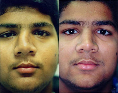 Rhinoplasty before and after photo