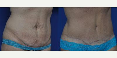 Tummy Tuck before and after photo