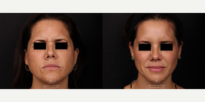 Botox before and after photo
