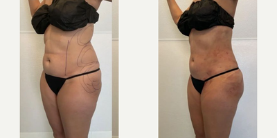 Brazilian Butt Lift before and after photo