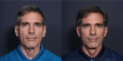Facelift before and after photo