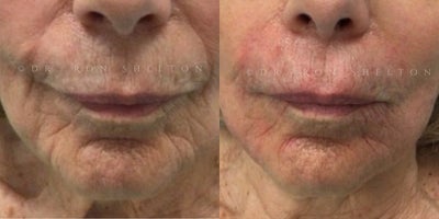 Dermal Fillers before and after photo
