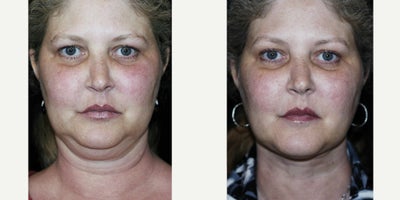 Liposuction before and after photo