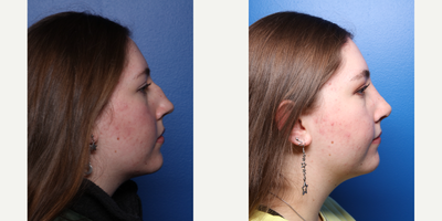 Rhinoplasty before and after photo
