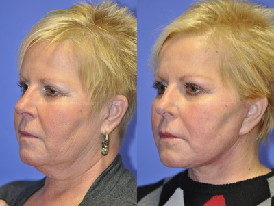 Skin Rejuvenation before and after photo