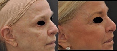 TCA Peel before and after photo