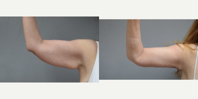 Arm Lift before and after photo