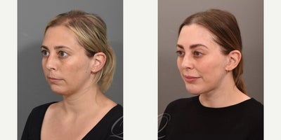 Facelift before and after photo