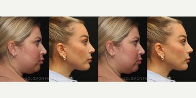 Facelift before and after photo