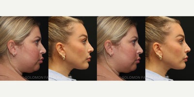 Facelift before and after photo