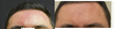 Halo Laser before and after photo