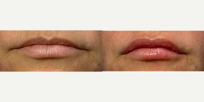 Juvederm before and after photo