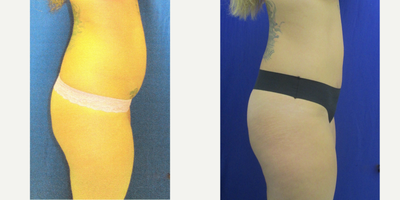 Liposuction before and after photo