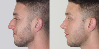 Rhinoplasty before and after photo