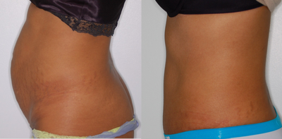 Tummy Tuck before and after photo