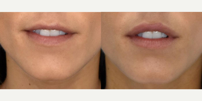 Vollure before and after photo