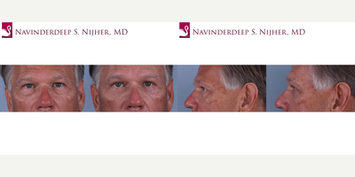 Eyelid Surgery before and after photo