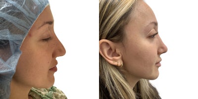 Rhinoplasty before and after photo