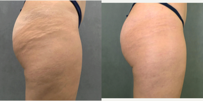 Secret RF before and after photo