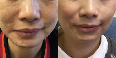 Xeomin before and after photo