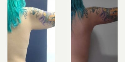 Arm Lift before and after photo