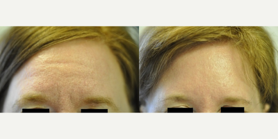 Botox before and after photo