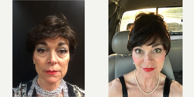 Bellafill before and after photo