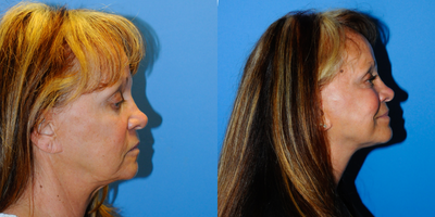 Facelift before and after photo