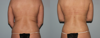 Liposuction before and after photo