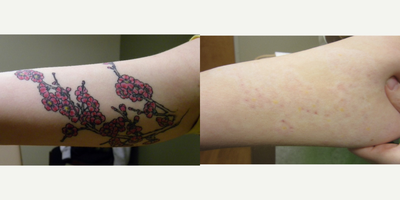 Tattoo Removal before and after photo