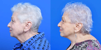 Facelift before and after photo