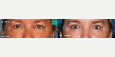 Laser Resurfacing before and after photo